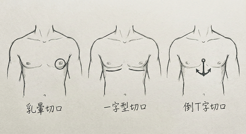 平胸手術切口位置